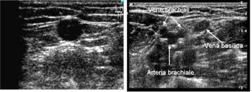 FAQ Cateteri PICC e Midline